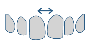 Glow Up Alineadores Transparentes para dientes separados