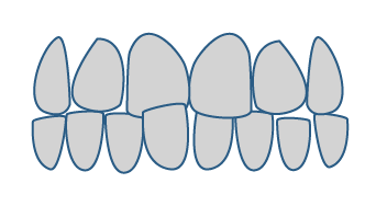 Glow Up Alineadores Transparentes para dientes cruzados