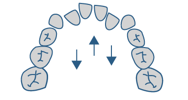 Glow Up Alineadores Transparentes para dientes apiñados