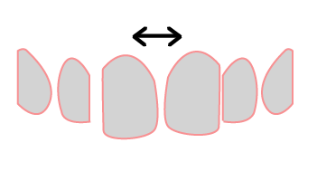 Dientes Separados