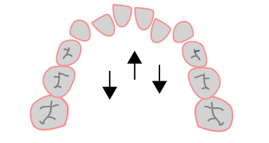 Dientes Apiñados