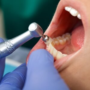 LIMPIEZA DENTAL CON ULTRASONIDO